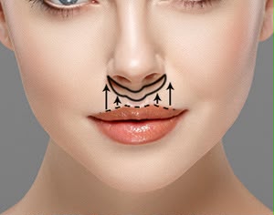 Lip Lift