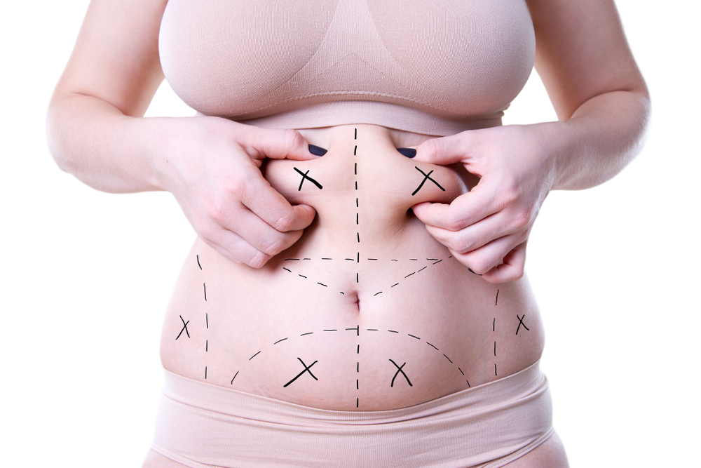 Tummy Tuck